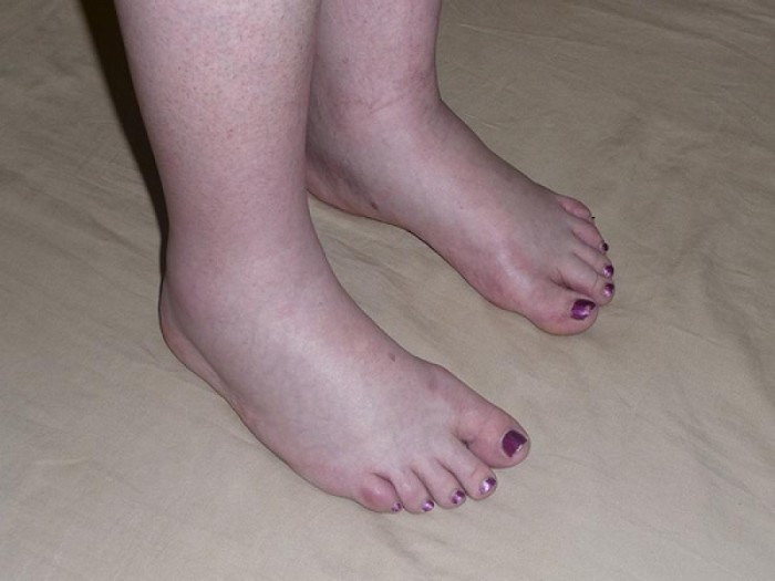 lábödéma ízületi betegségben azt jelenti, hogy ízületi fájdalom
