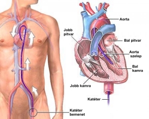 Mi okozza a szívinfarktust?