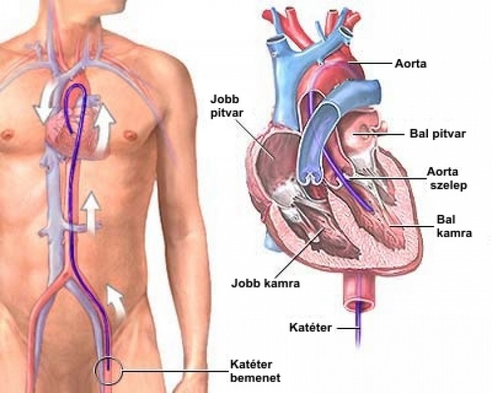 Mi okozza a szívinfarktust?